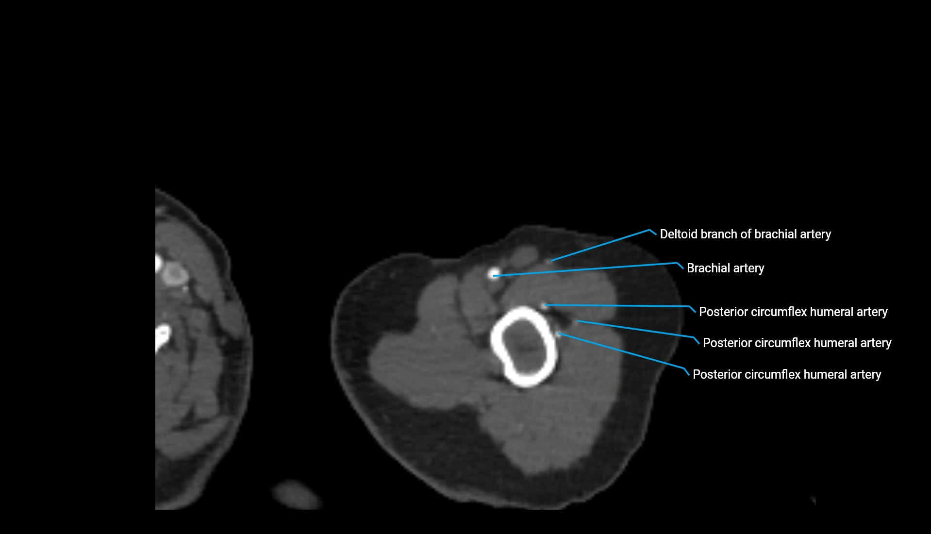 CTA upper limb axial cross sectional anatomy labelled image 309 (1).webp